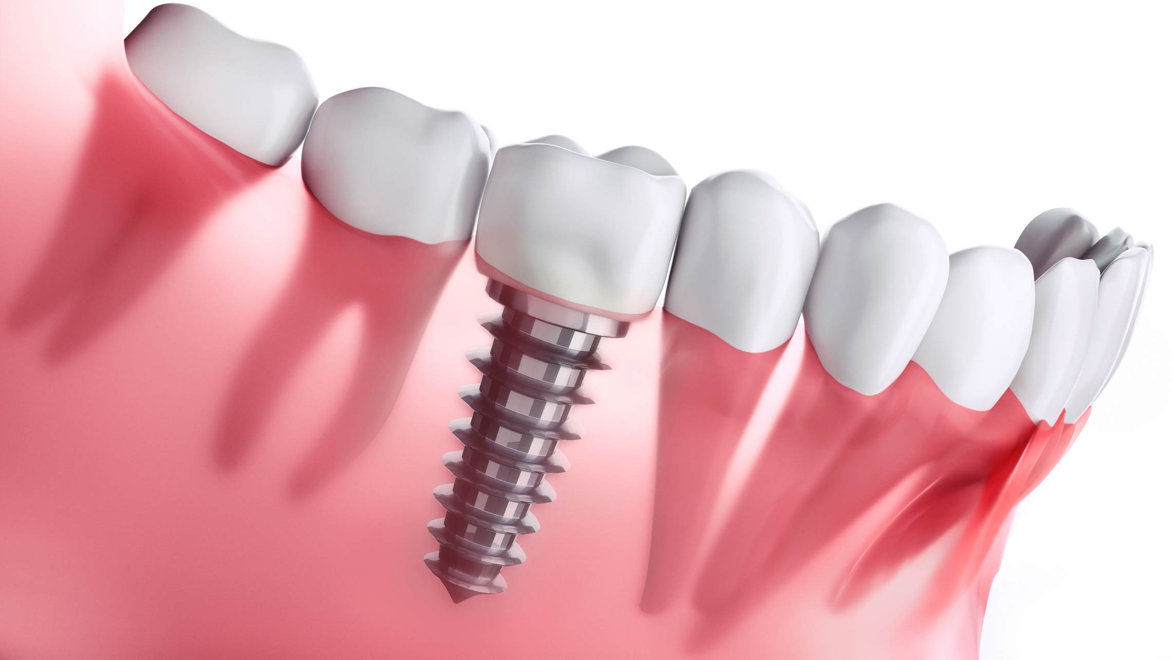 Implants