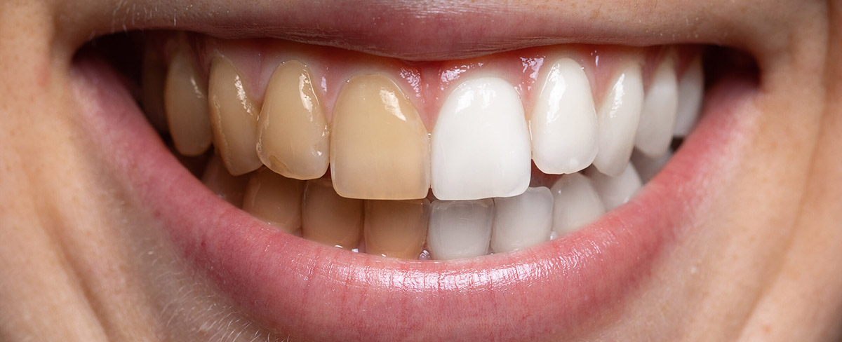 Teeth Whitening